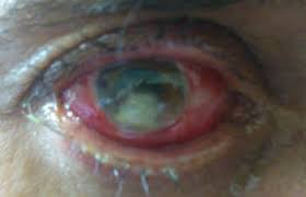 From the diagnosis of infectious keratitis to discriminating fungal subtypes a deep learning-based study